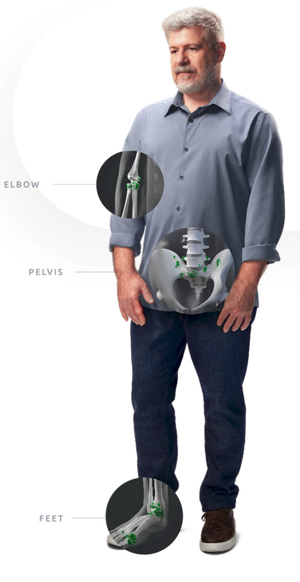An image of a man with artistic overlays highlighting tophi in elbow, pelvis, and foot
