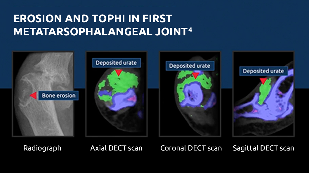 Picture of tophi in metatarsophalangeal joint and associated bone erosion in radiographs and DECT scans